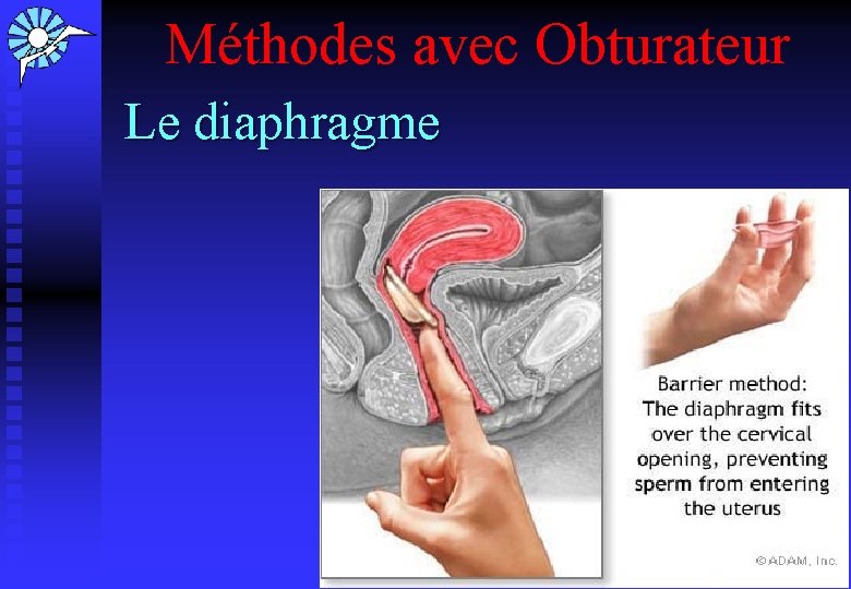 Méthodes avec Obturateur Le diaphragme 