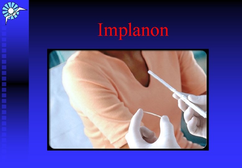 Implanon 