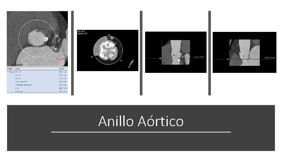 Anillo Aórtico 