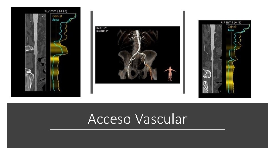 Acceso Vascular 