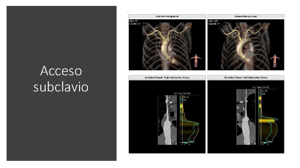 Acceso subclavio 