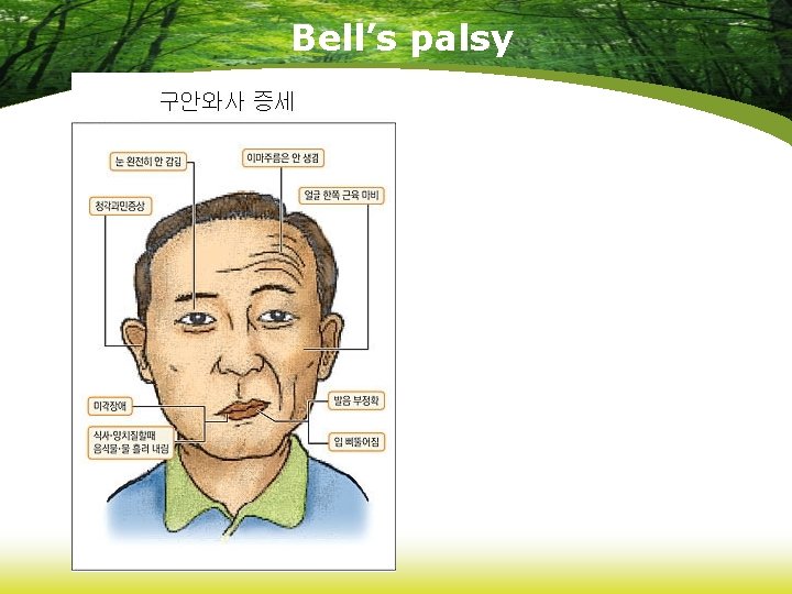Bell’s palsy 