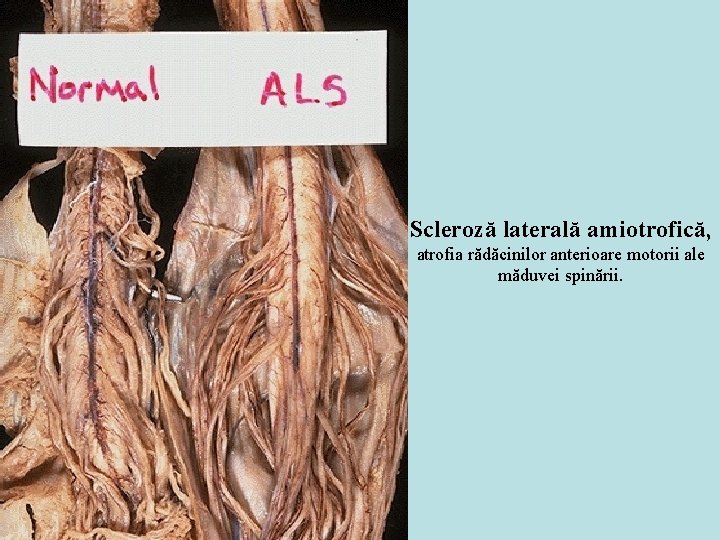 Scleroză laterală amiotrofică, atrofia rădăcinilor anterioare motorii ale măduvei spinării. 