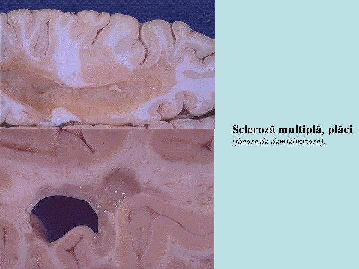 Scleroză multiplă, plăci (focare de demielinizare). 