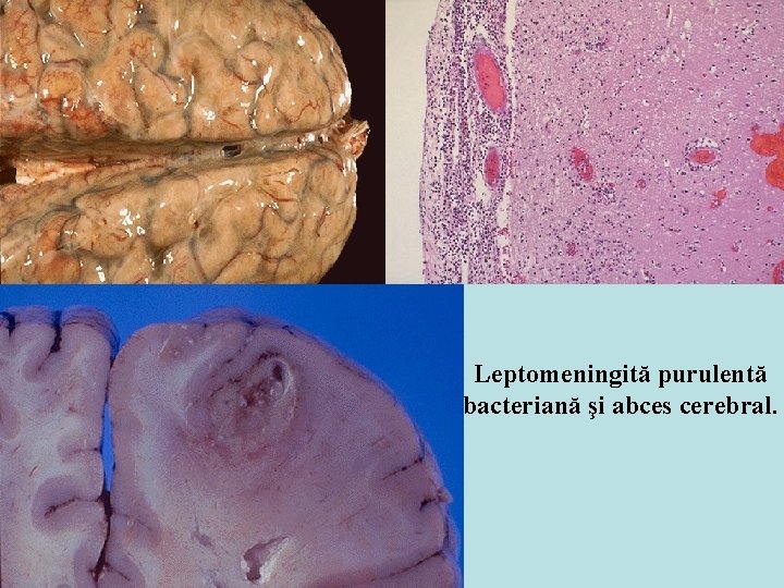 Leptomeningită purulentă bacteriană şi abces cerebral. 