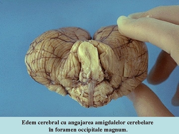 Edem cerebral cu angajarea amigdalelor cerebelare în foramen occipitale magnum. 