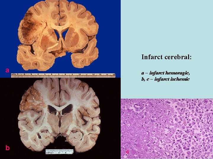 Infarct cerebral: a b a – infarct hemoragic, b, c – infarct ischemic c