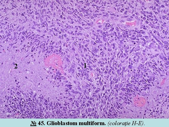 2 1 № 45. Glioblastom multiform. (coloraţie H-E). 