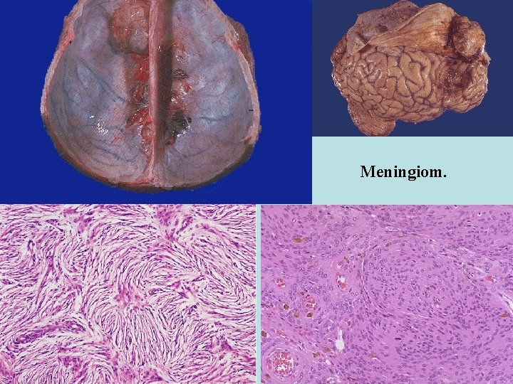 Meningiom. 