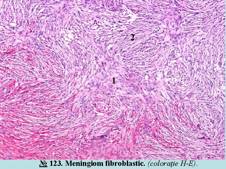 2 1 № 123. Meningiom fibroblastic. (coloraţie H-E). 