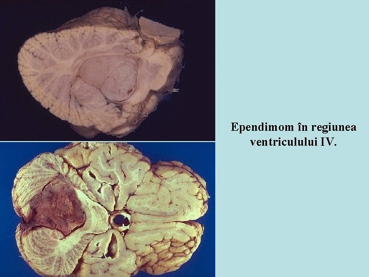 Ependimom în regiunea ventriculului IV. 