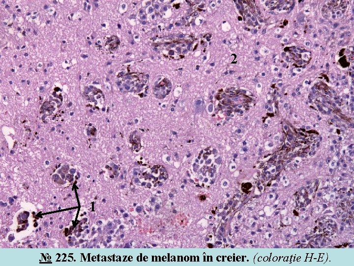 2 1 № 225. Metastaze de melanom în creier. (coloraţie H-E). 