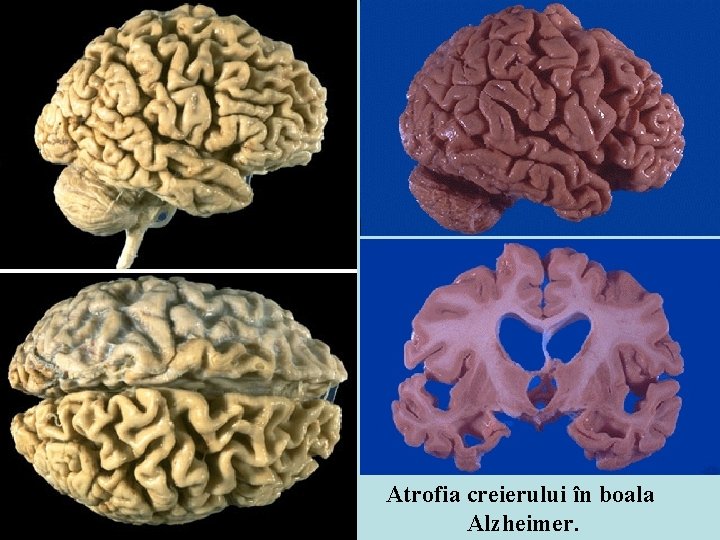 Atrofia creierului în boala Alzheimer. 