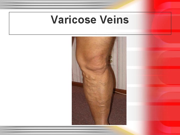 Varicose Veins 