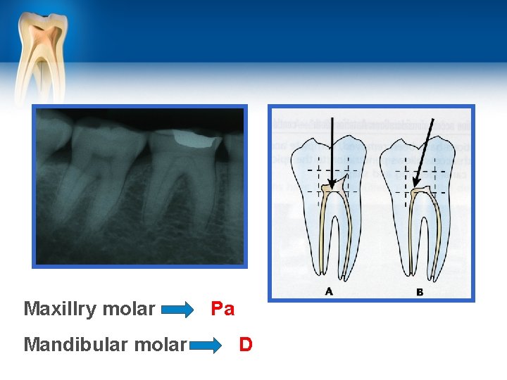 Maxillry molar Mandibular molar Pa D 