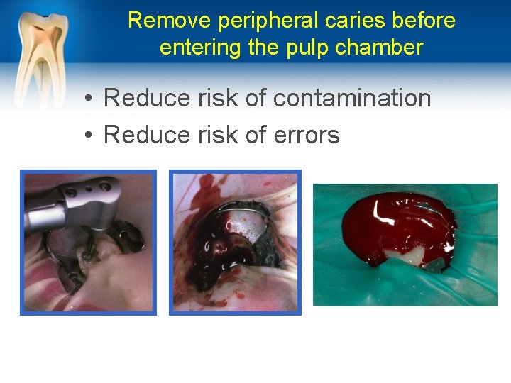 Remove peripheral caries before entering the pulp chamber • Reduce risk of contamination •