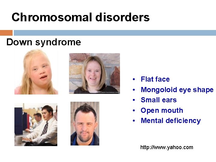 Chromosomal disorders Down syndrome • • • Flat face Mongoloid eye shape Small ears