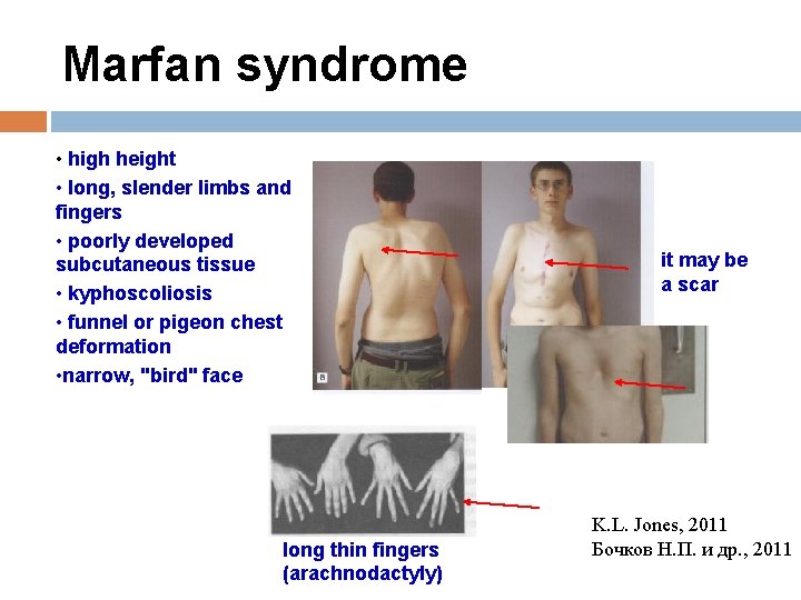 Marfan syndrome • high height • long, slender limbs and fingers • poorly developed