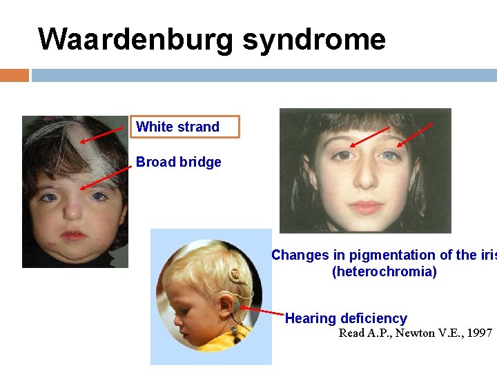 Waardenburg syndrome White strand Broad bridge Changes in pigmentation of the iris (heterochromia) Hearing