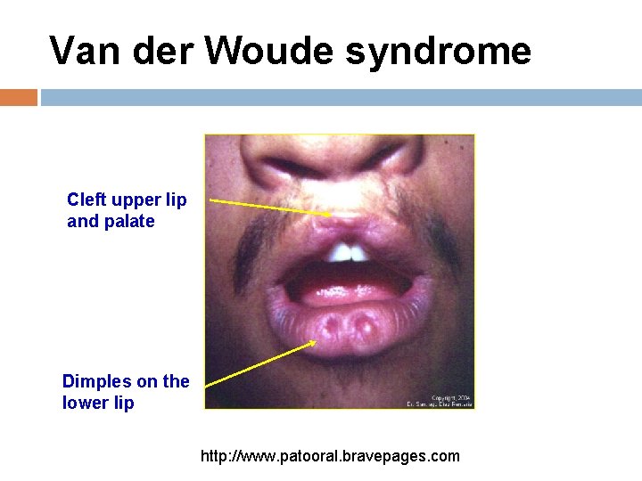 Van der Woude syndrome Cleft upper lip and palate Dimples on the lower lip