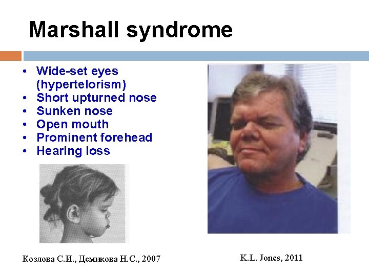 Marshall syndrome • Wide-set eyes (hypertelorism) • Short upturned nose • Sunken nose •