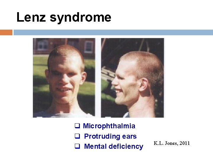 Lenz syndrome q Microphthalmia q Protruding ears q Mental deficiency K. L. Jones, 2011