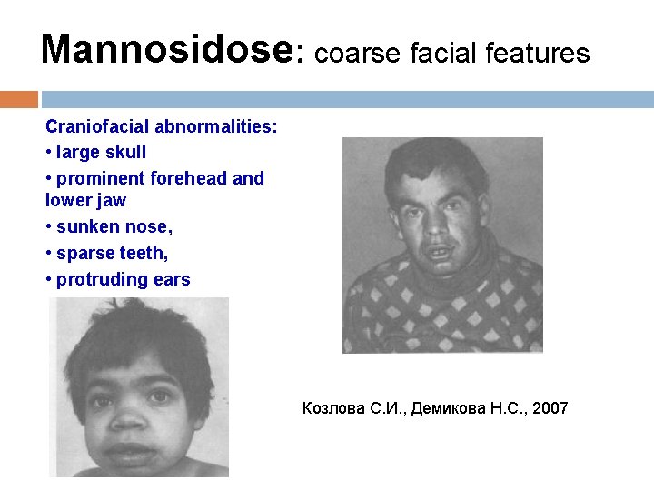 Mannosidose: coarse facial features Craniofacial abnormalities: • large skull • prominent forehead and lower