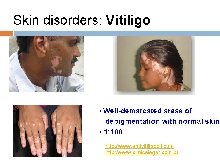 Skin disorders: Vitiligo • Well-demarcated areas of depigmentation with normal skin • 1: 100