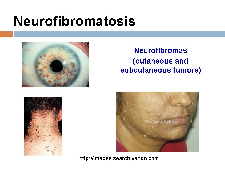 Neurofibromatosis Neurofibromas (cutaneous and subcutaneous tumors) http: //images. search. yahoo. com 