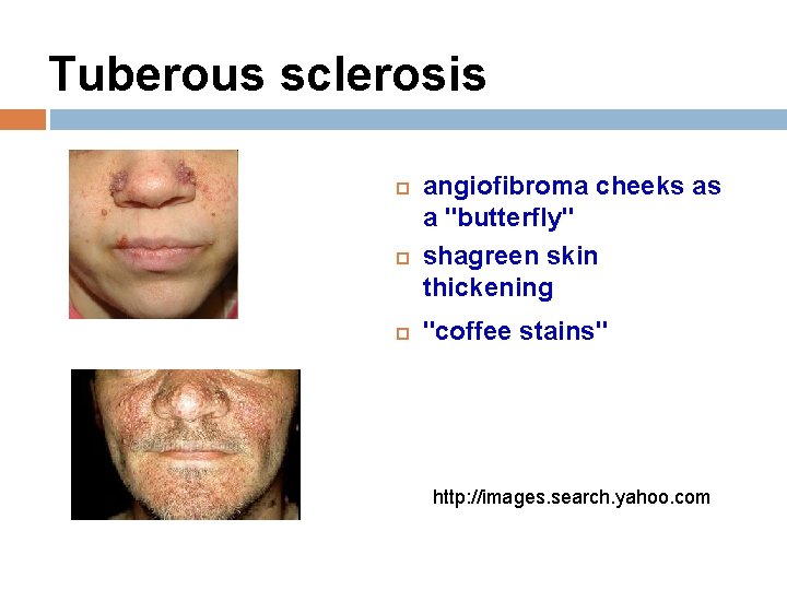 Tuberous sclerosis angiofibroma cheeks as a "butterfly" shagreen skin thickening "coffee stains" http: //images.