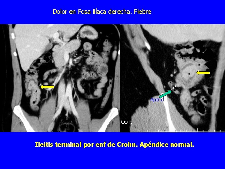Dolor en Fosa ilíaca derecha. Fiebre Apend. Oblic Ileitis terminal por enf de Crohn.