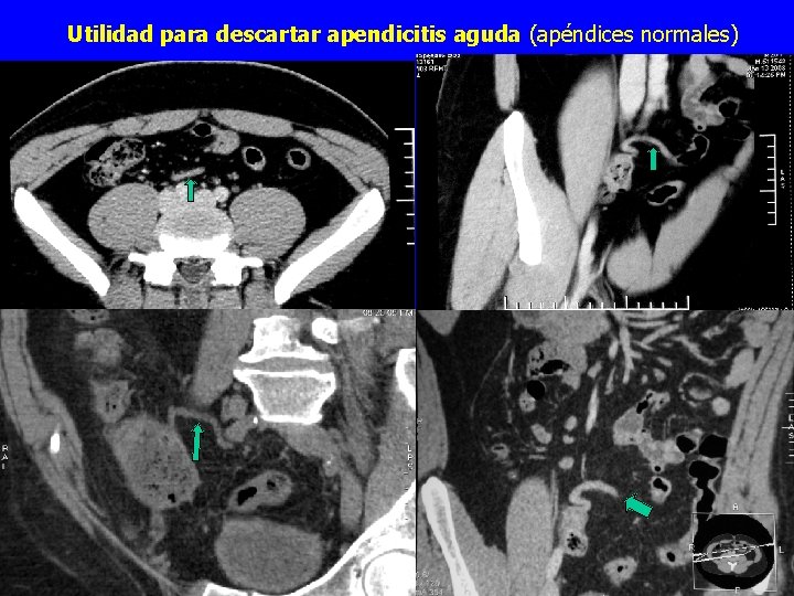 Utilidad para descartar apendicitis aguda (apéndices normales) 