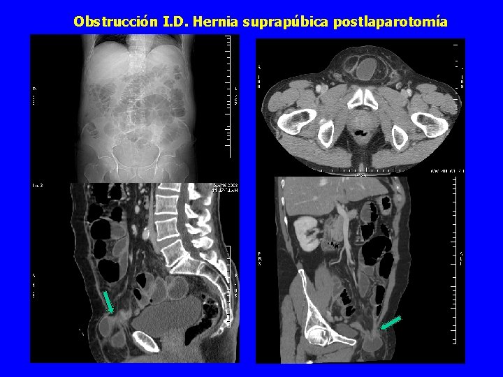 Obstrucción I. D. Hernia suprapúbica postlaparotomía 