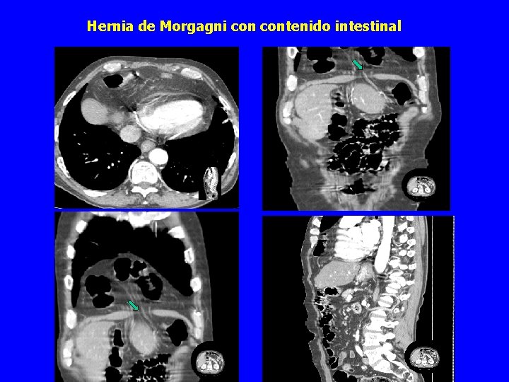 Hernia de Morgagni contenido intestinal 