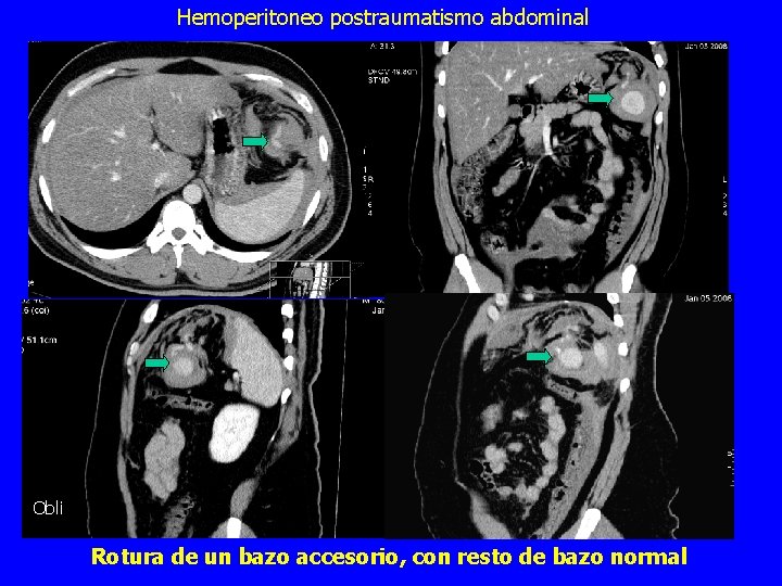 Hemoperitoneo postraumatismo abdominal Obli Rotura de un bazo accesorio, con resto de bazo normal