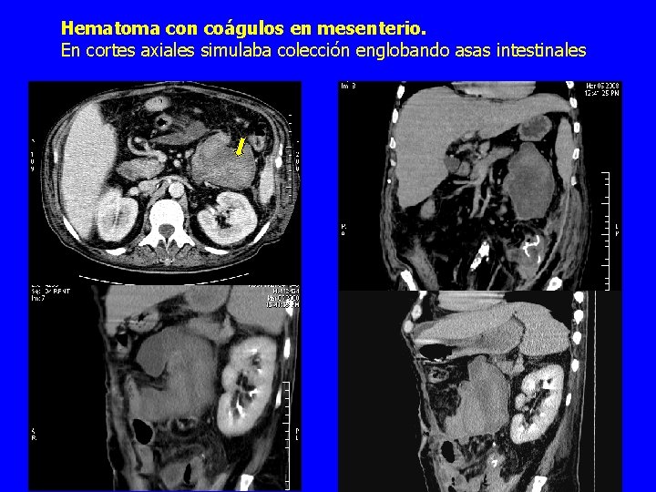 Hematoma con coágulos en mesenterio. En cortes axiales simulaba colección englobando asas intestinales 