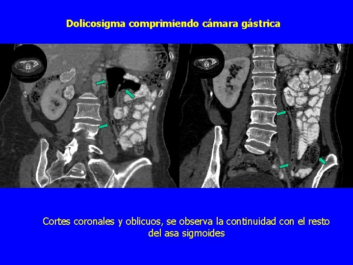 Dolicosigma comprimiendo cámara gástrica Cortes coronales y oblicuos, se observa la continuidad con el
