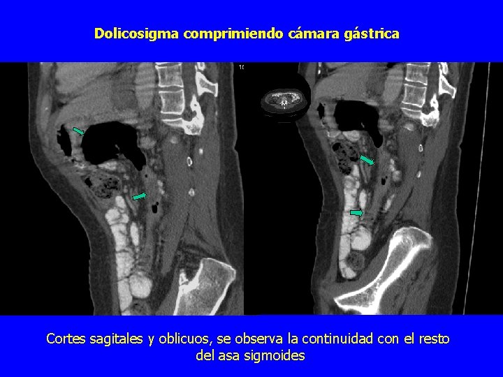 Dolicosigma comprimiendo cámara gástrica Cortes sagitales y oblicuos, se observa la continuidad con el