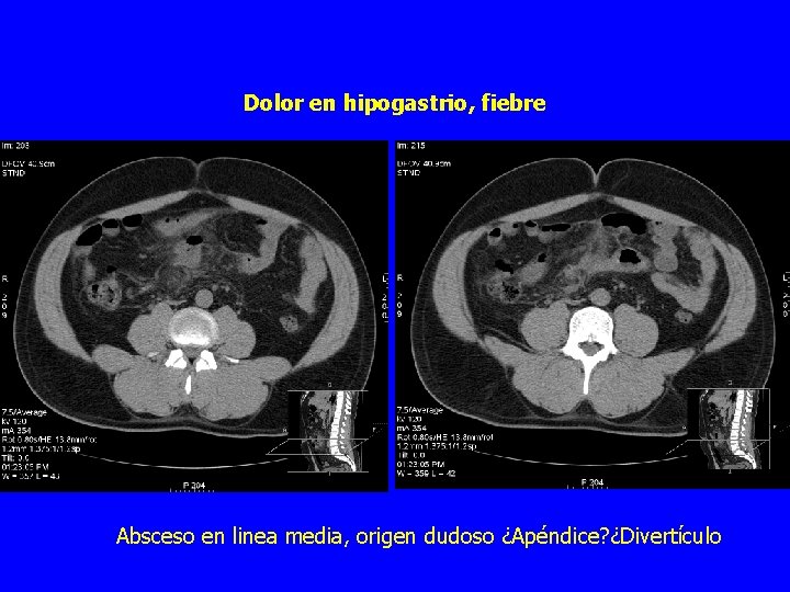 Dolor en hipogastrio, fiebre Absceso en linea media, origen dudoso ¿Apéndice? ¿Divertículo 