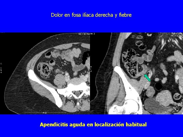 Dolor en fosa ilíaca derecha y fiebre Apendicitis aguda en localización habitual 