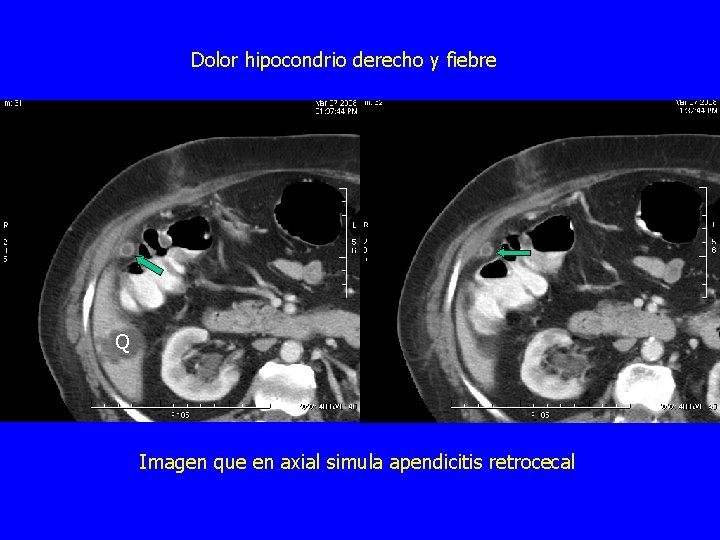Dolor hipocondrio derecho y fiebre Q Imagen que en axial simula apendicitis retrocecal 