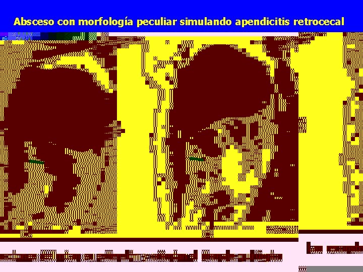 Absceso con morfología peculiar simulando apendicitis retrocecal Q Las reconstrucciones delimitan su extensión y