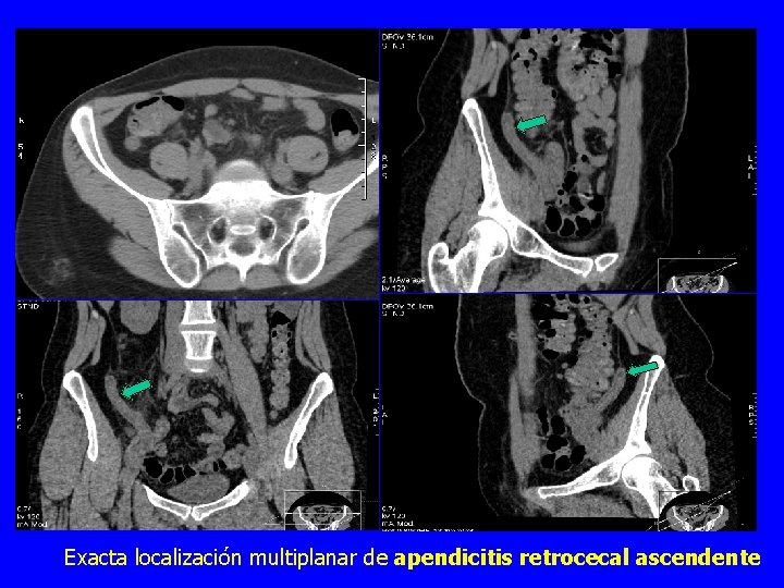 Exacta localización multiplanar de apendicitis retrocecal ascendente 