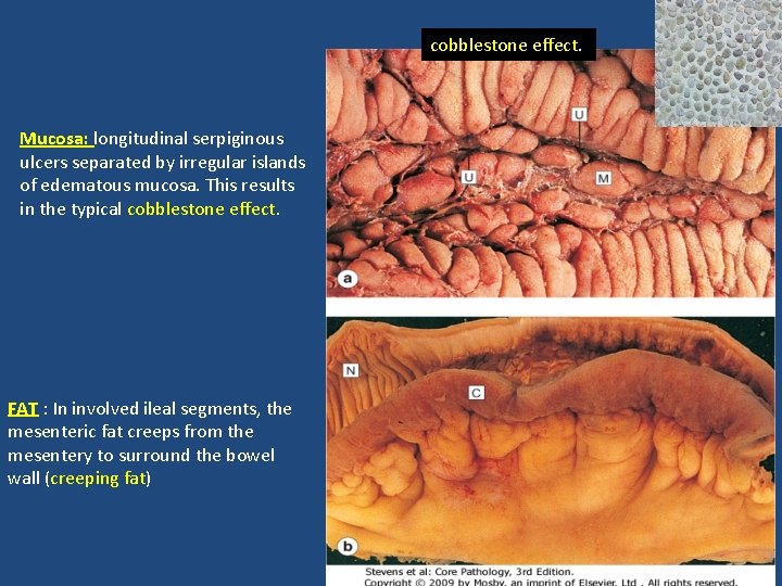 cobblestone effect. Mucosa: longitudinal serpiginous ulcers separated by irregular islands of edematous mucosa. This