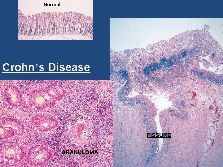Normal Crohn’s Disease FISSURE GRANULOMA 