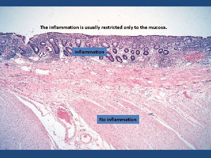 The inflammation is usually restricted only to the mucosa. inflammation No inflammation 