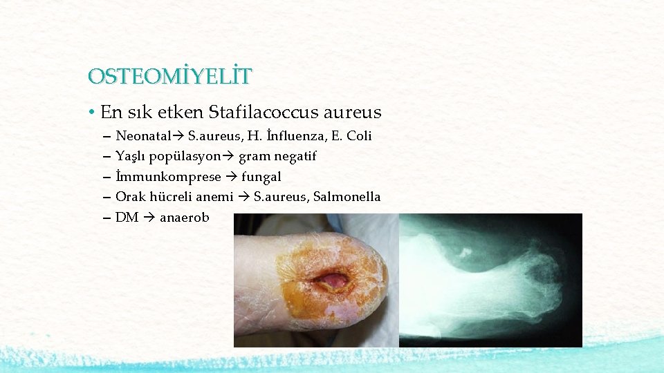 OSTEOMİYELİT • En sık etken Stafilacoccus aureus – – – Neonatal S. aureus, H.