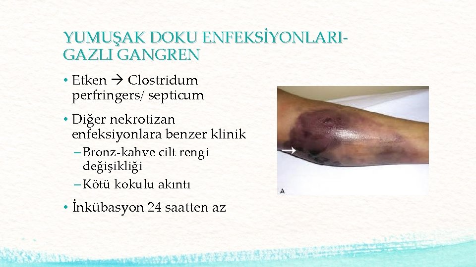 YUMUŞAK DOKU ENFEKSİYONLARIGAZLI GANGREN • Etken Clostridum perfringers/ septicum • Diğer nekrotizan enfeksiyonlara benzer