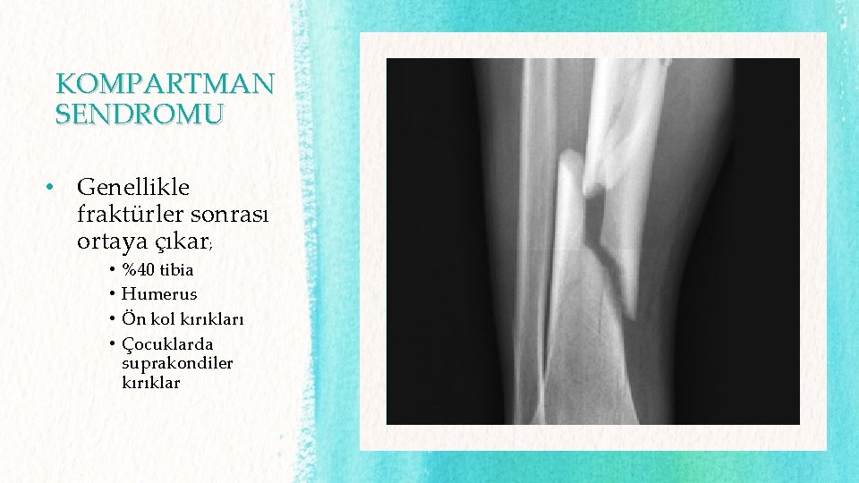 KOMPARTMAN SENDROMU • Genellikle fraktürler sonrası ortaya çıkar; • • %40 tibia Humerus Ön