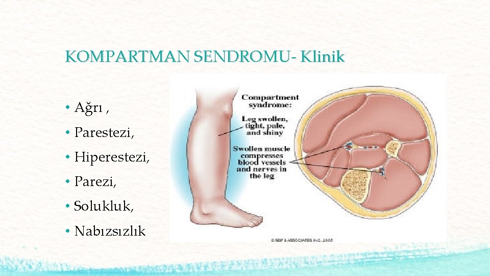 KOMPARTMAN SENDROMU- Klinik • Ağrı , • Parestezi, • Hiperestezi, • Parezi, • Solukluk,